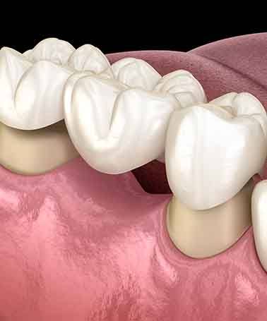 A dental bridge is a durable, functional way to replace lost teeth