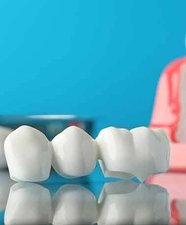 A dental bridge is a prosthetic tooth restoration