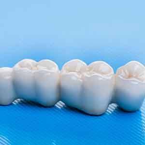Traditional dental bridges can be made of ceramic or porcelain