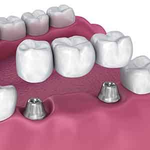 Implant bridges securely hold your dental bridge in place with a dental implant
