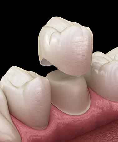 dental crowns can restore a damaged tooth