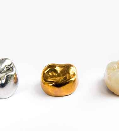 A dental crown is a deluxe filling that can restore a damaged or decayed tooth