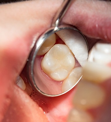 Closeup of a tooth with a filling