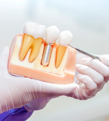 Dentist holding model of dental implant in Roswell, GA