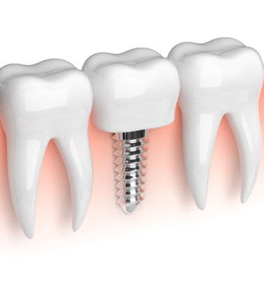 Illustration of a dental implant in Roswell, GA