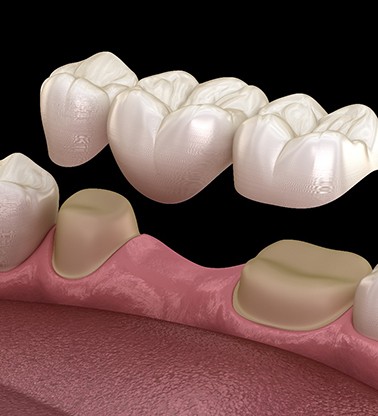 Digital image of a dental bridge