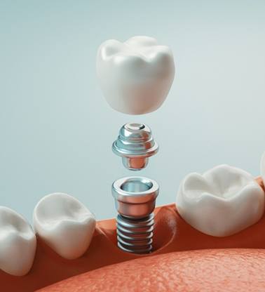 An up-close image of a dental implant
