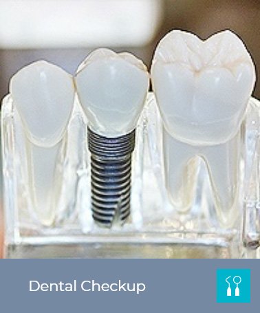 Model of a dental implant