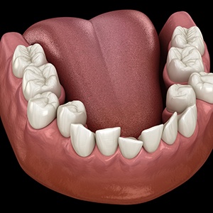 Illustration of crooked teeth