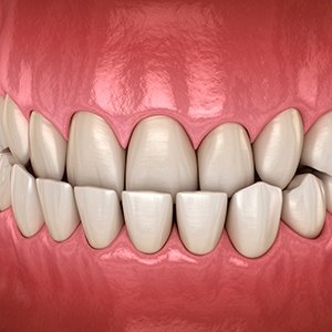 Illustration of an underbite