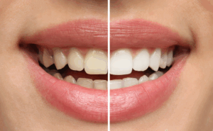 a photo demonstrating the results of teeth whitening treatment